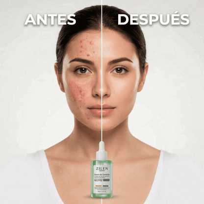 Sérum Anti Rojeces de Centella Zilen (100ml)